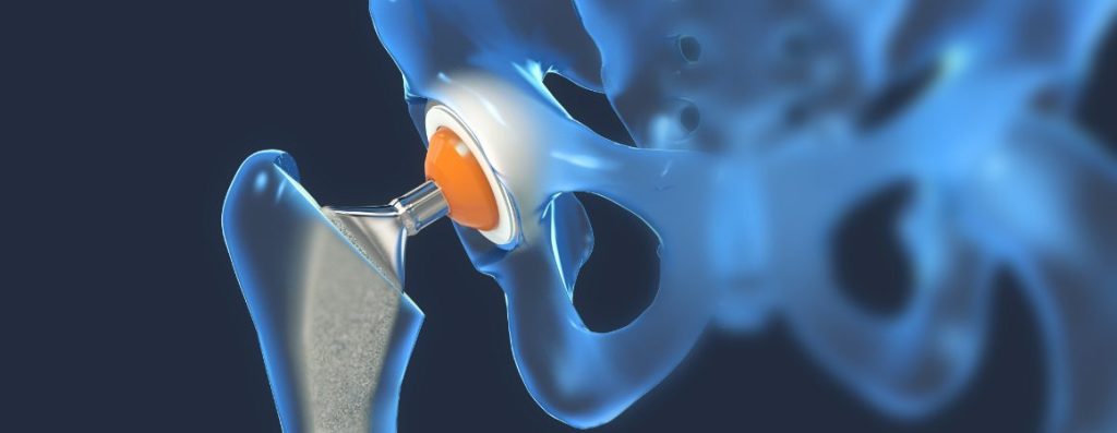 Possible Complications From Hip Replacement Surgery