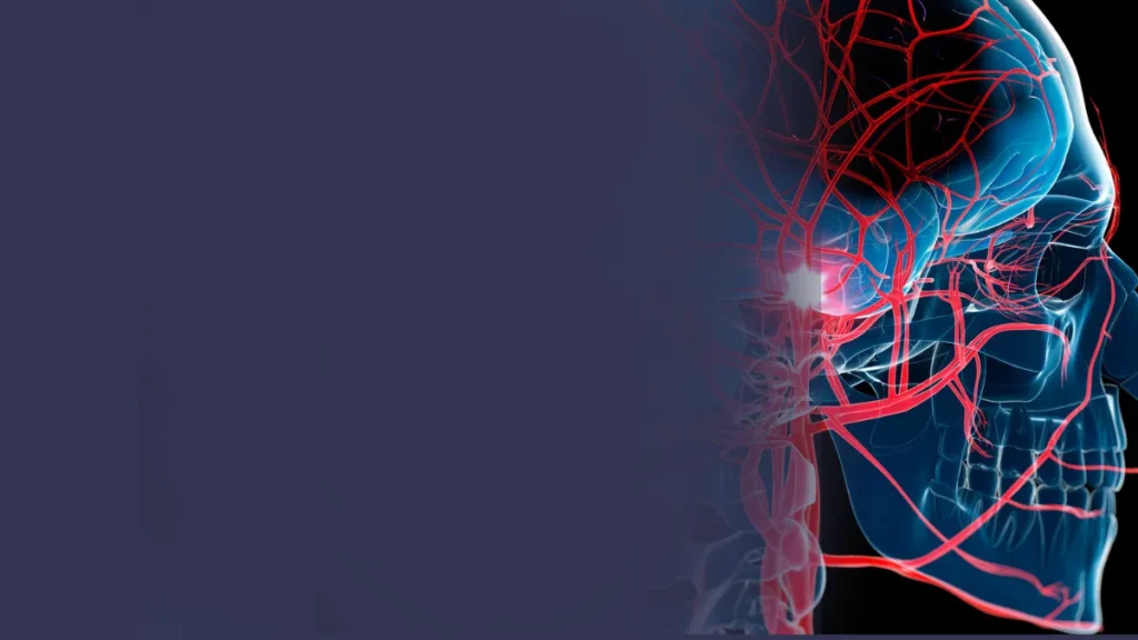 Stroke Misdiagnosis | Stroke Malpractice | Orlando Lawyer